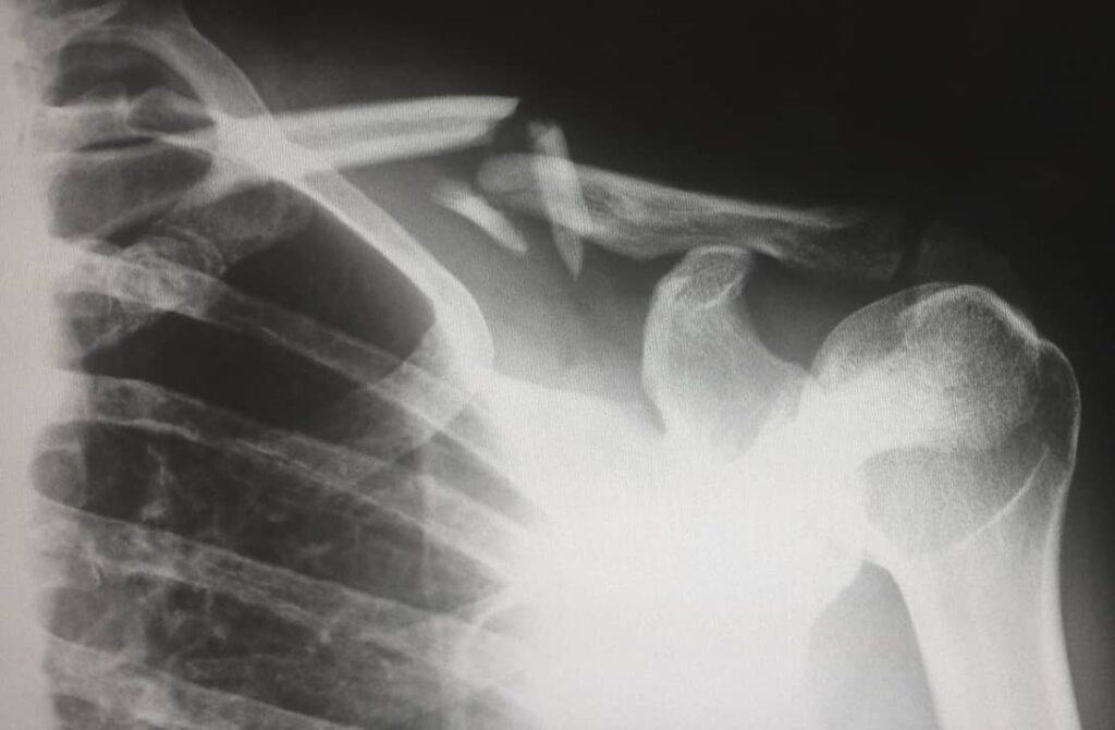 Catastrophic-Injury