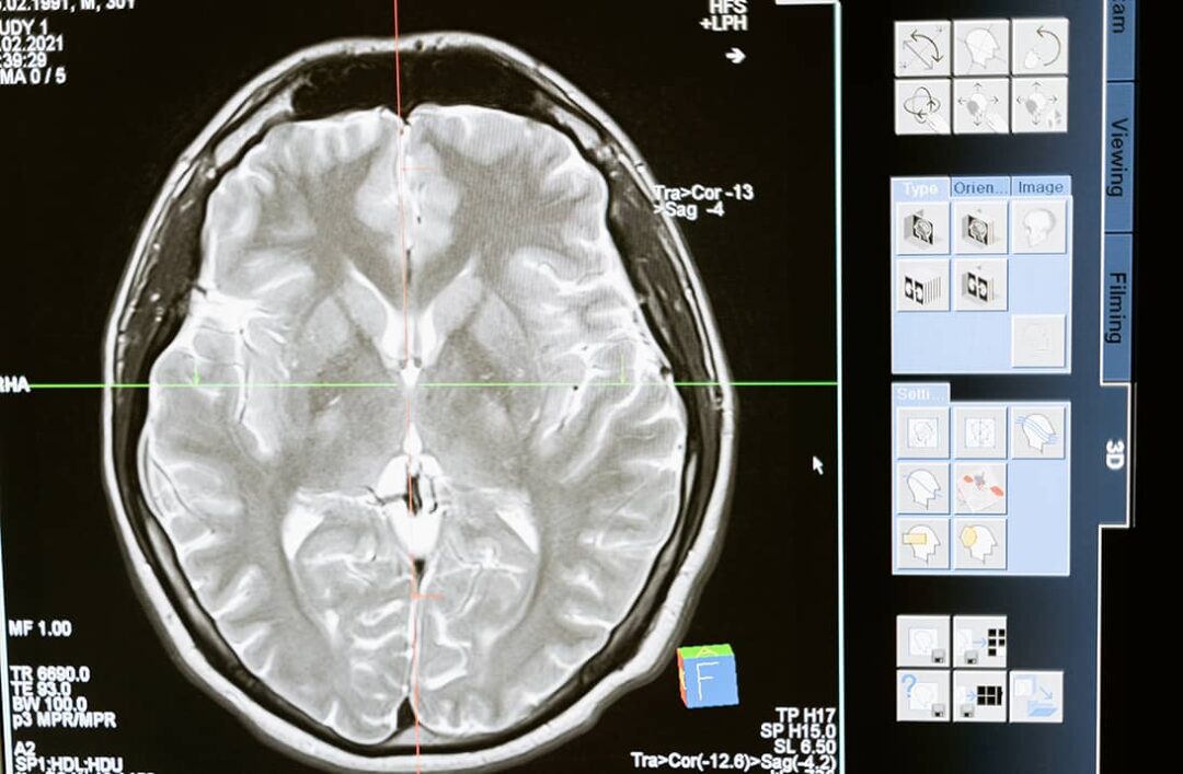 brain scan